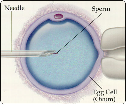 Intracytoplasmic Sperm Injection Detailed