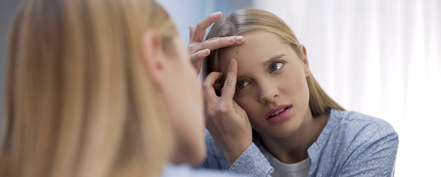 Mujer con acné hormonal después de suspender los anticonceptivos